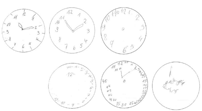 digital-clock-test:-detect-dementia-with-neural-networks